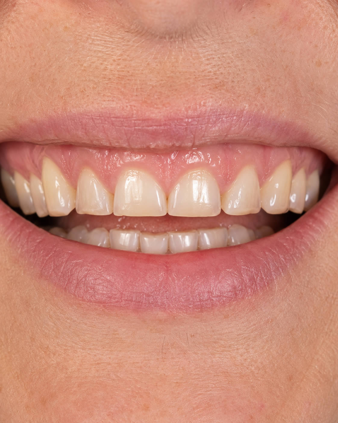 Dents de devant usées ou trop courtes