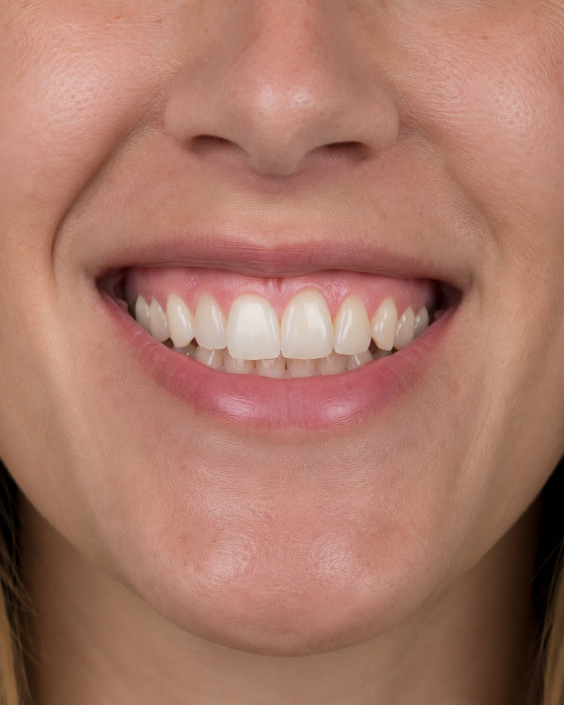 Défauts de forme ou de position des dents de devant