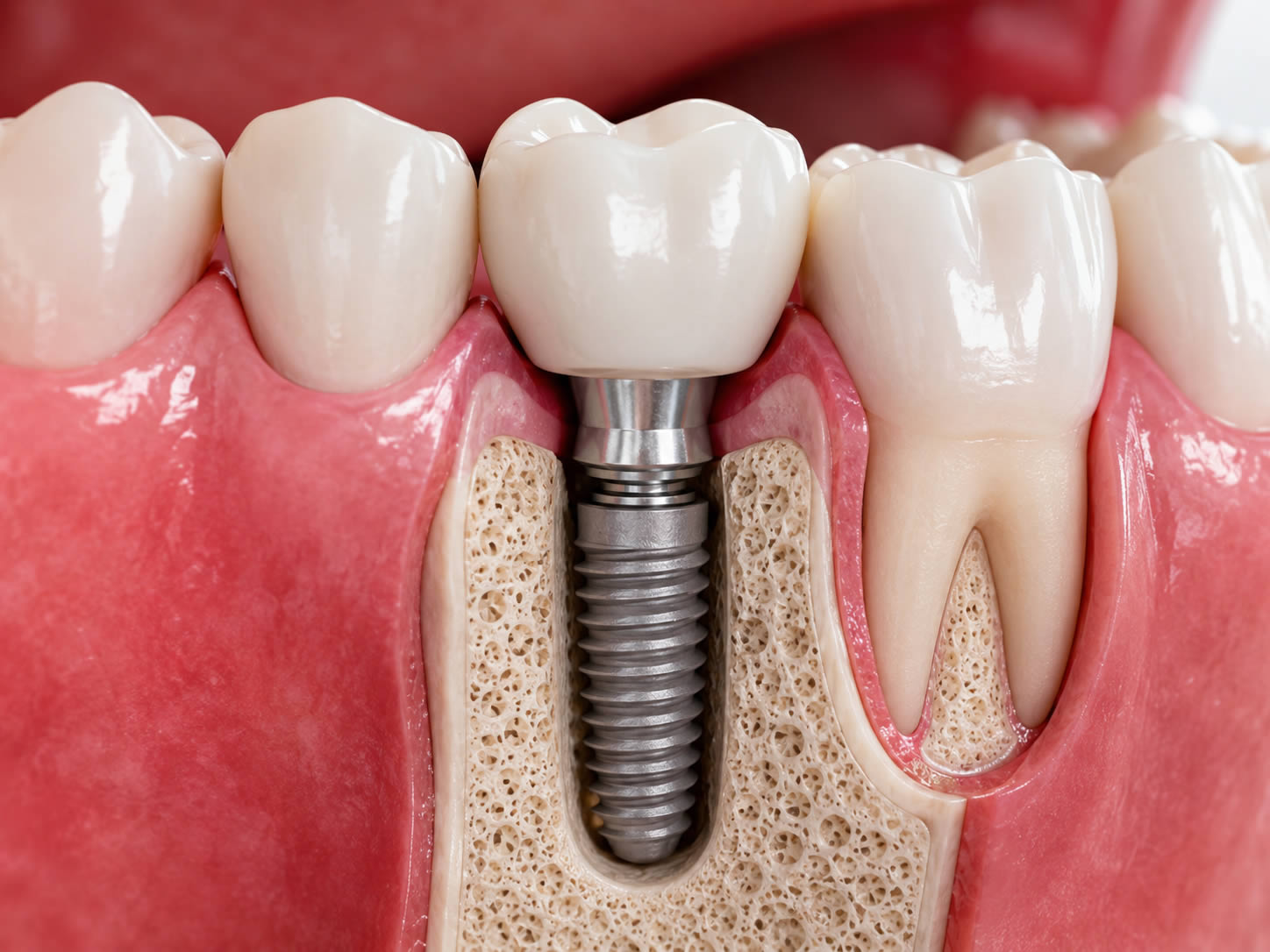 Implant dentaire pour remplacer une dent de devant