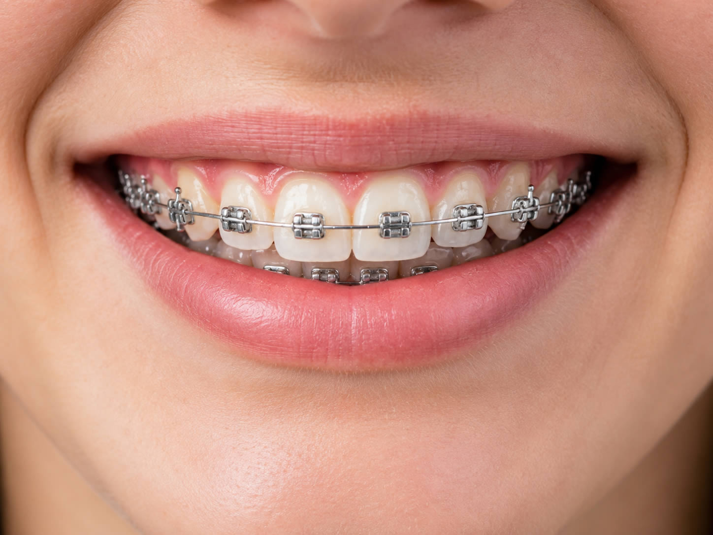 Orthodontie pour corriger l’alignement des dents de devant
