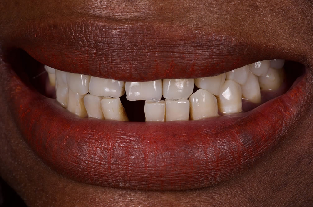 Sourire avant réhabilitation complète, cas 1