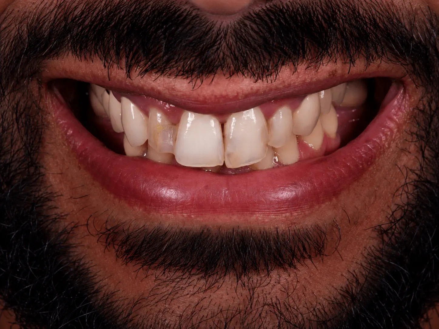 Sourire avant réhabilitation dentaire