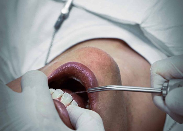 Solutions pour soulager durablement la sensibilité dentaire