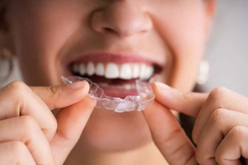 Orthodontie Invisalign invisible