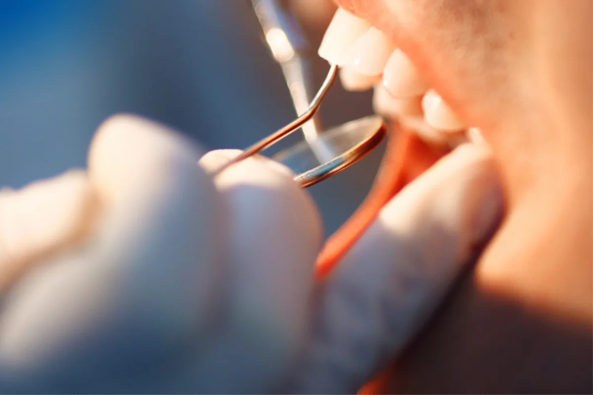 Traitement des caries