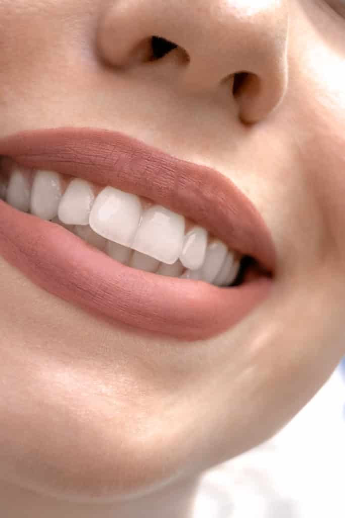 Corriger le sourire gingival