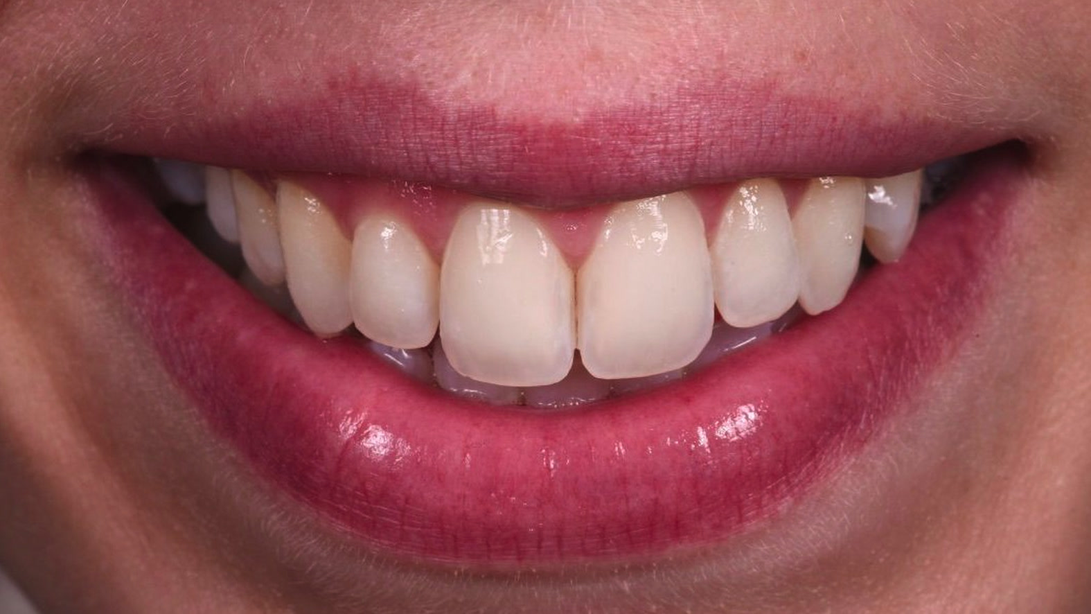 Dentiste traitement fluorose après