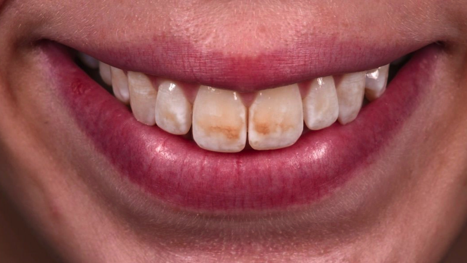 Dentiste traitement fluorose avant