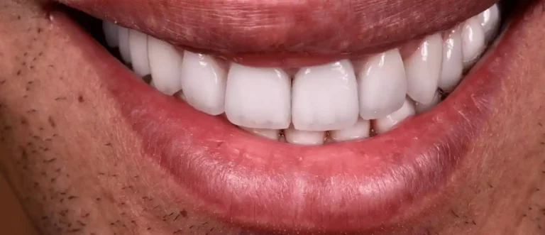 Traitement de la fluorose dentaire après — cas 1