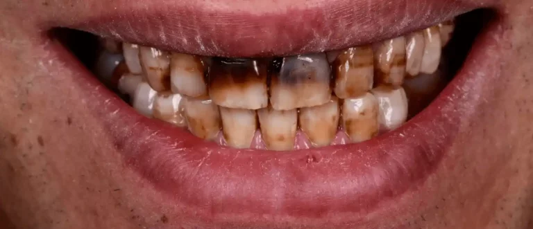 Traitement de la fluorose dentaire avant — cas 1