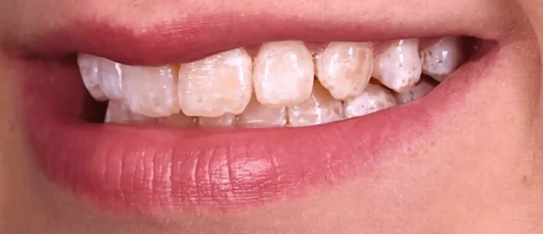 Traitement de la fluorose dentaire avant — cas 2