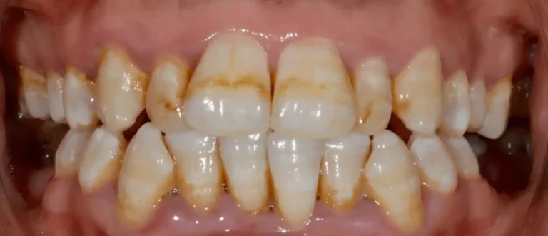 Traitement de la fluorose dentaire avant — cas 3