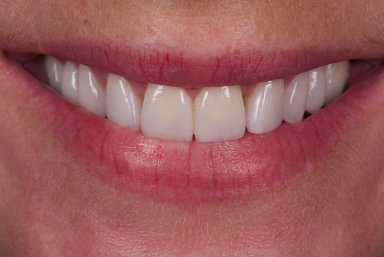 Facettes en composite pour taches de fluorose
