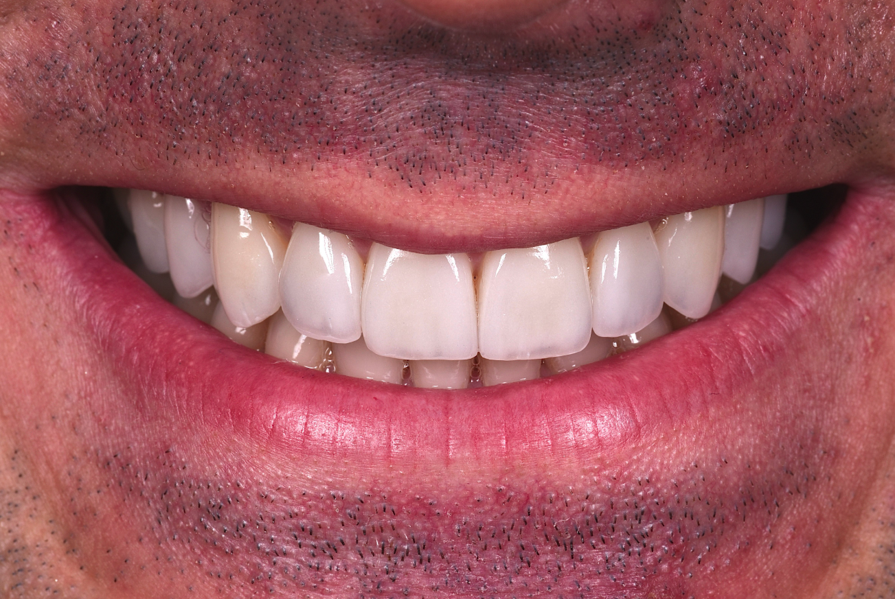 Polissage des dents après fluorose