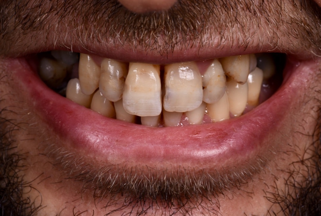 Avant traitement parodontal cas 2